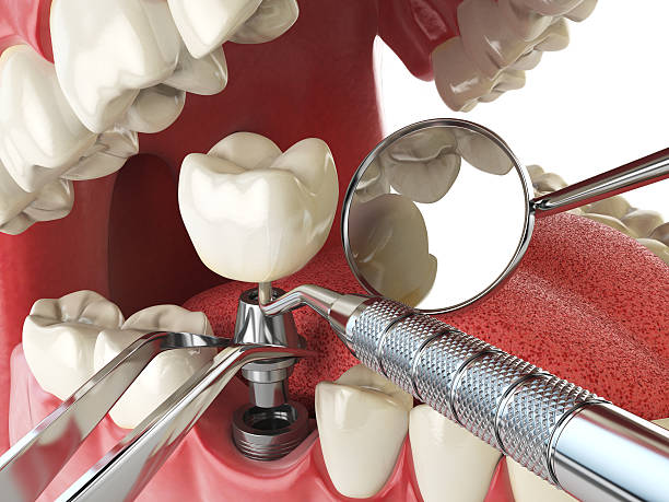 Best Emergency Wisdom Teeth Removal in Pooler, GA